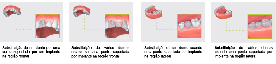 implantes